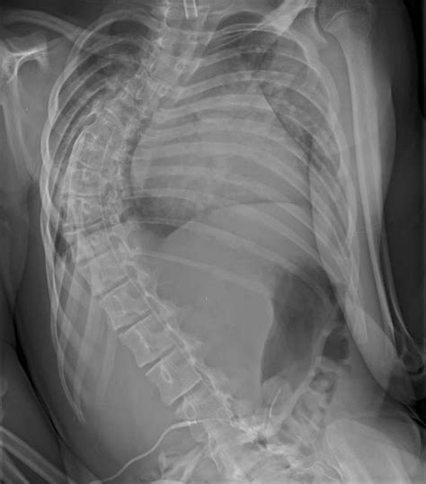 Orthokids Neuromuscular Scoliosis