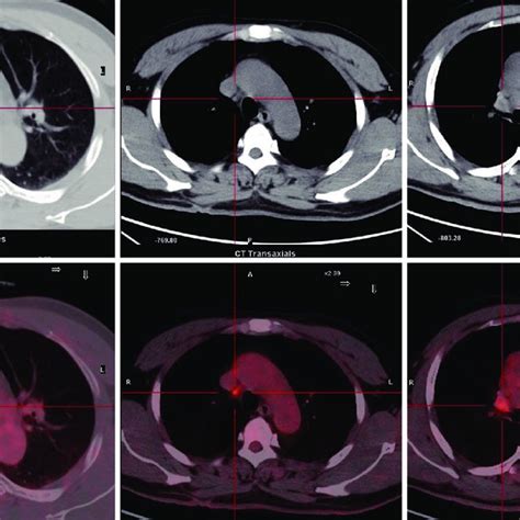 The Pet Ct Scan Assessment Of One Cycle Alectinib Ln Lymph Node