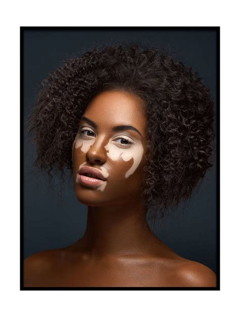 Pin By On Portraits Vitiligo Model Vitiligo Beauty