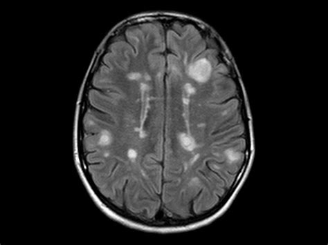 The lesions detected with mri are pathologically nonspecific. FDA Approves Ocrevus for Relapsing, Primary Progressive MS