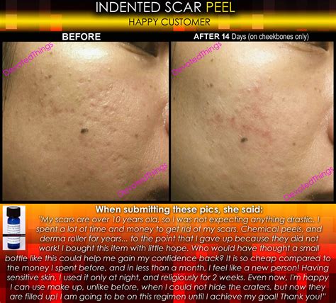 Indented Acne Scar Removal Peel Chicken Pox Ice Pick Rolling Boxcar