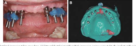 Figure 1 From Full Mouth Rehabilitation With Implant Supported Fixed