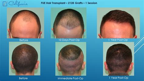 Fue Hair Transplant Recovery Timeline Fergusashley