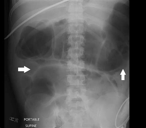X Ray Abdomen Showing Marked Gaseous Distension Of The Stomach And
