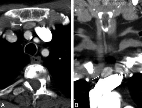 Diagnostic Accuracy Of 4d Ct For Parathyroid Adenomas And Hyperplasia