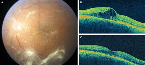 Intravitreal Triamcinolone For Diabetic Macular Edema Nejm