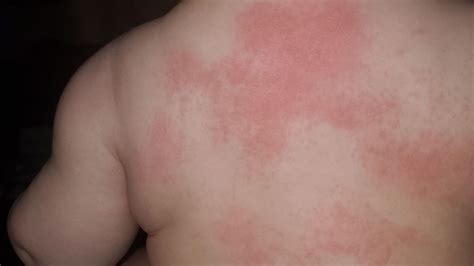 Infant Diagnosed With Covid 19 Parents Tipped Off By Rash