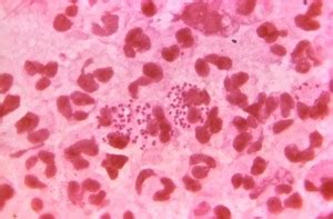 Gonorrhea, colloquially known as the clap, is a sexually transmitted infection (sti) caused by the bacterium neisseria gonorrhoeae. Gonorrhea outbreak declared in Spokane County | The Global ...