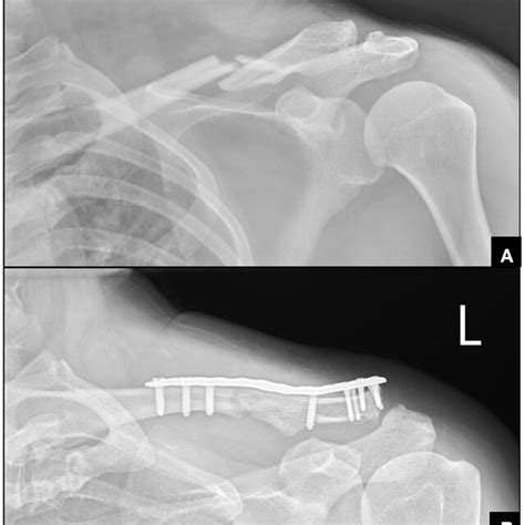 Radiography For The Clavicle Fracture A Left Middle Third Clavicle