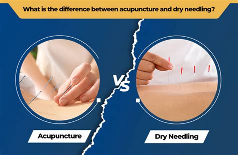 know the difference between dry needling and acupuncture