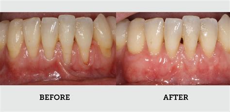 Before And After Gallery White Bear Lake Dentist Mn 55110