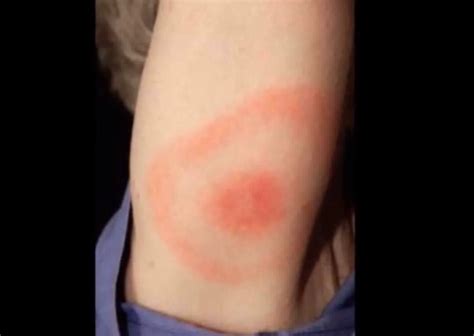 Brown Recluse Bite Pictures Stages Symptoms Treatment HubPages