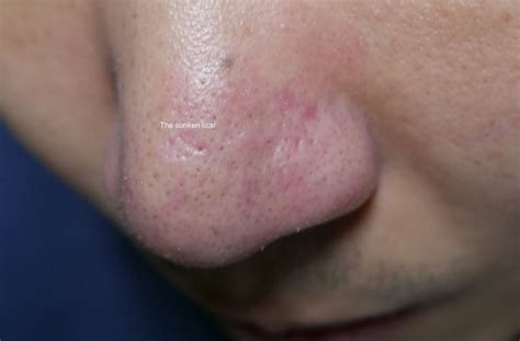 Scars On Nose Scar Treatments