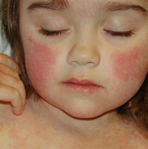 A Visual Guide To Viral Rashes Viral Rash Rash On Face Skin Images And Photos Finder