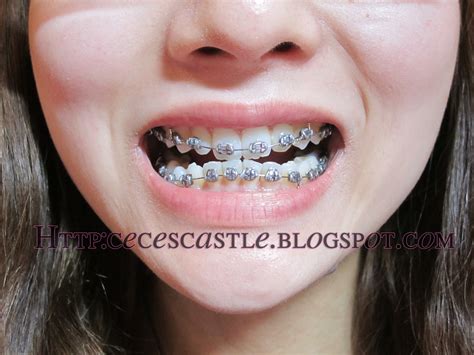 Their purpose is to pressurize teeth to make proper space for each other. Beauty ♥ Fashion ♥Life: Vlog: All about my Braces - 7 ...