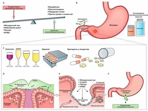 Перфоративная язва желудка и двенадцатиперстной кишки - презентация онлайн Картинка - Перфоративная язва желудка и двенадцатиперстной кишки - презентация онлайн