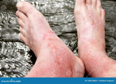 Sunburn On The Skin Of The Foot And Ankle Stock Photo Image Of