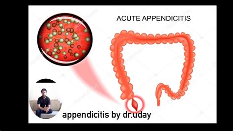 Appendicitis Causessymptomstreatments अपेंडिक्स क्या क्यों By Dr
