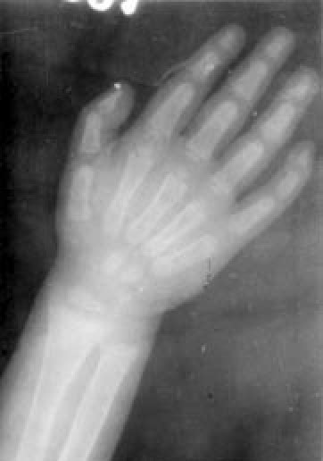 X Ray Of The Wrist Showing Changes Of Rickets At The Epiphysial End Of