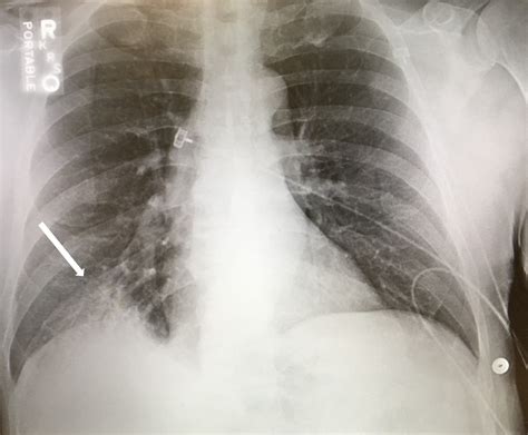 Legionella Pneumonia Chest X Ray
