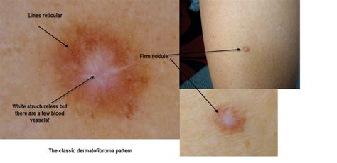 Ficha 3 Criterios Dermatoscopicos En Dermatofibroma Dermatologia En