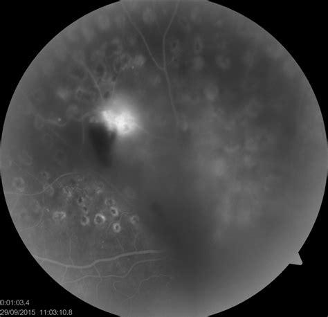 Figure Fundus Fluorescein Angiography Of The Statpearls Ncbi