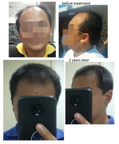 For thicker scalp skin, many people recommend 1.5 mm to puncture the skin and epidermis sufficiently. How Often To Microneedle For Hair Loss? It Depends ...