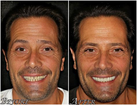 All On 4® Dental Implants Before And After Photos Center 4 Smiles