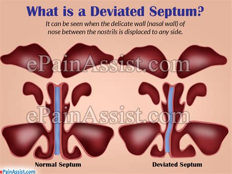 Deviated Septum What Causes Septal Deviation And How To Fix It