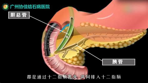 Ppt 内镜下胰胆管造影术（ercp）的治疗与护理腾讯视频