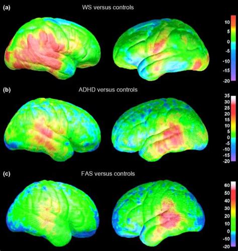 Adhd Brain Mri Neuroimaging In Child And Adolescent Psychiatric