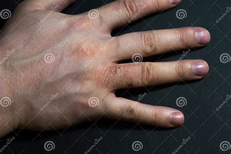 Hand Dermatitis Hand Eczema Stock Image Image Of Isolated Painful