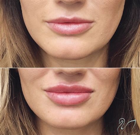 Syringe Of Juvederm Lips Before And After Lipstutorial Org
