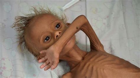 اليمن شبح المجاعة يتخطف الأطفال Political الجزيرة نت
