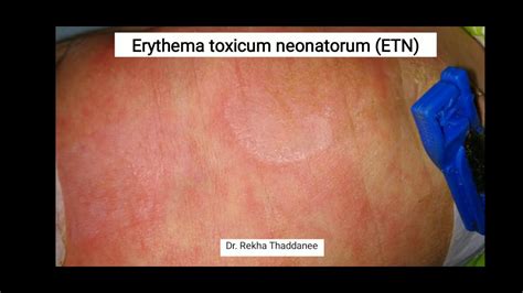 Erythema Toxicum Neonatorum Pediatrics Youtube