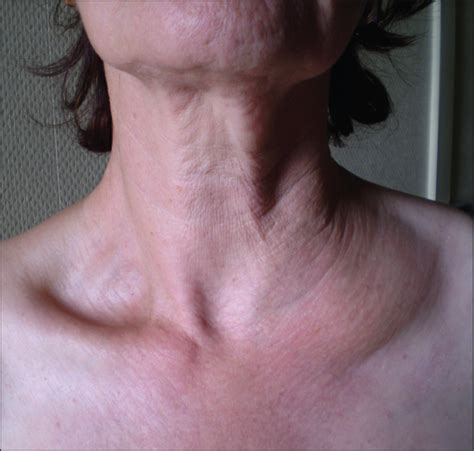 Lymfeklieren Hals