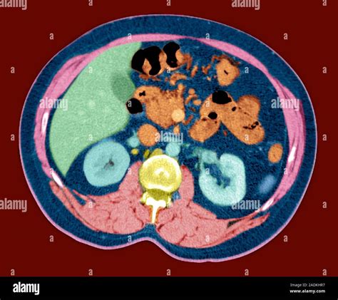 Normal Kidneys Coloured Axial Horizontal Ct Computed Tomography