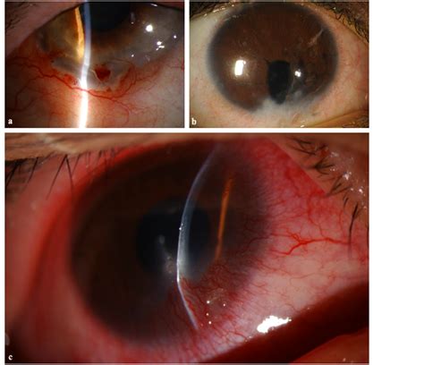 Phlyctenulosis Like Presentation Secondary To Embedded Corneal Foreign Body