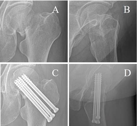 Typical Case Of Three Hollow Screws For Femoral Neck Fractures A