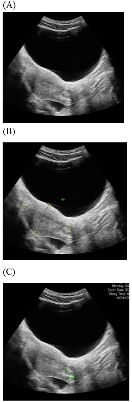 transabdominal ultrasound image shows a longitudinal section of the download scientific diagram