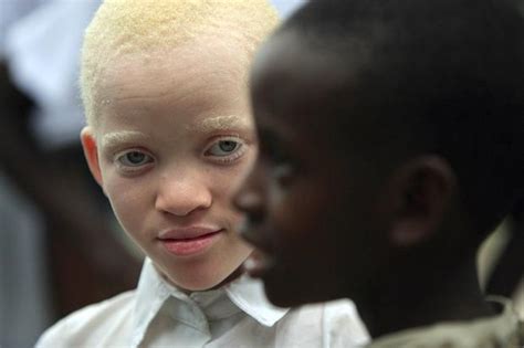 Malawi Debates Death Penalty To Halt Attacks On Albinos