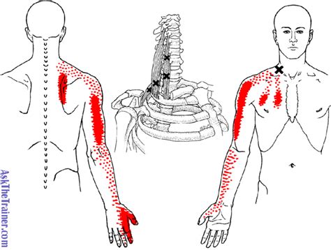 Pin On Referred Pain
