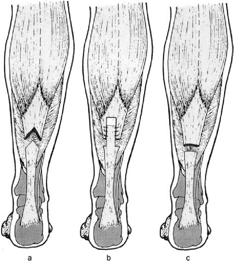 Diagrams Of Other Techniques Of Aponeurotic Lengthening Showing A