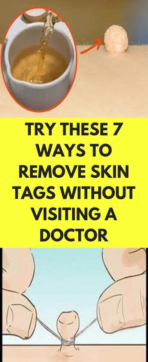 try these 7 ways to remove skin tags without visiting a doctor skin tag removal skin tag