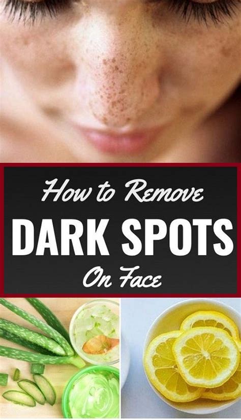 Dark Spots Causes Types And Natural Treatment Healthy Lifestyle