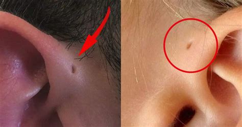Why Do Some People Have This Tiny Hole Above Their Ears Heres What It