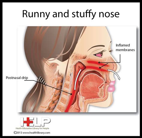 Runny And Stuffy Nose Stuffy Nose Health Education Nose