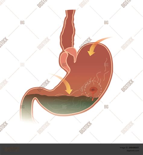 Stomach Peptic Ulcer Vector And Photo Free Trial Bigstock
