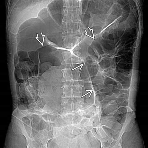 Sigmoid Volvulus Radiology Key