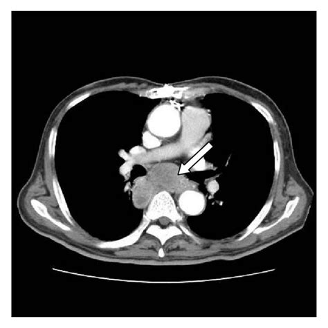 Chest Computed Tomography Scan Shows The Multiple Metastatic Lymph